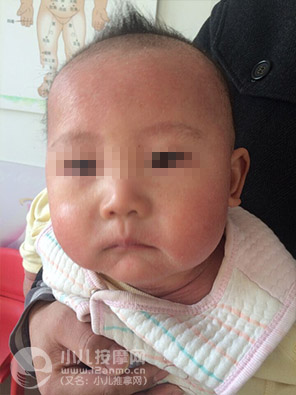 小儿推拿调理幼儿湿疹案例图片9