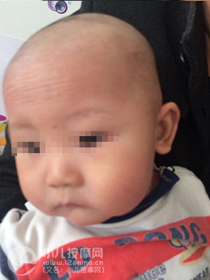 小儿推拿调理幼儿湿疹案例图片11