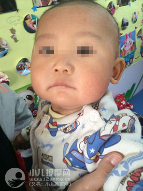 小儿推拿调理幼儿湿疹案例图片13